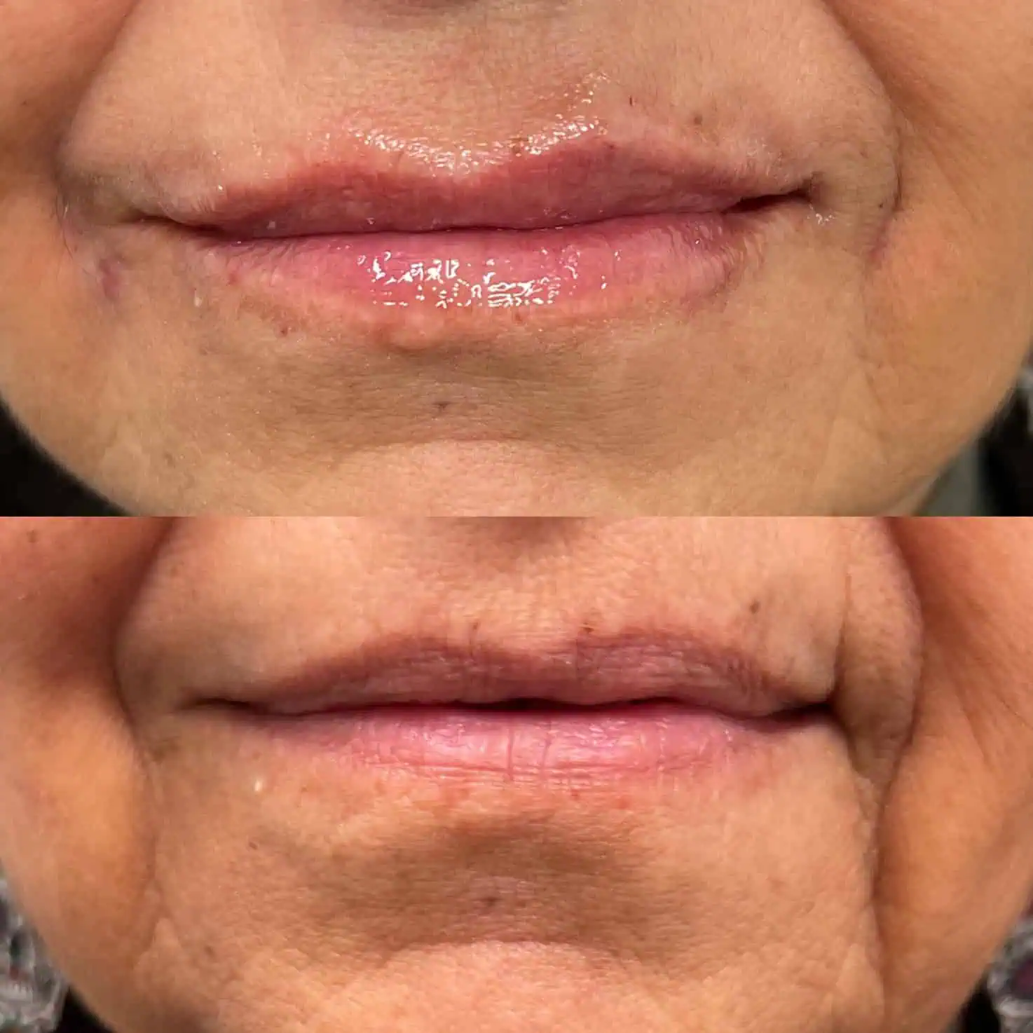 Lip-before-after