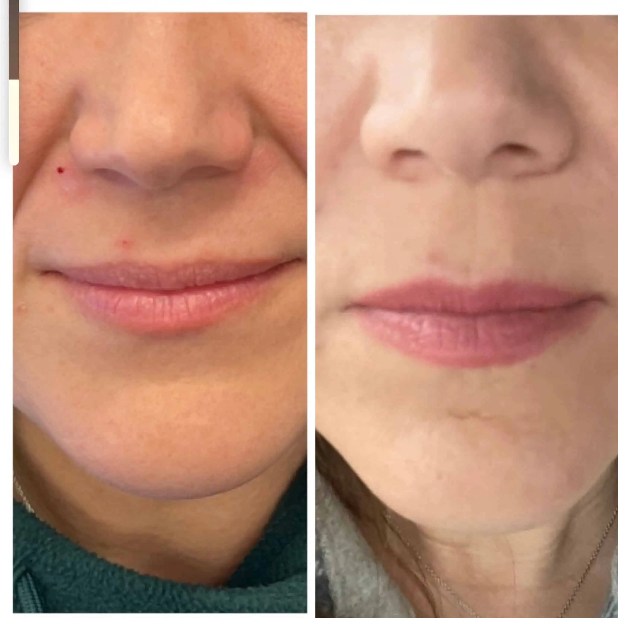 Lips-before-after