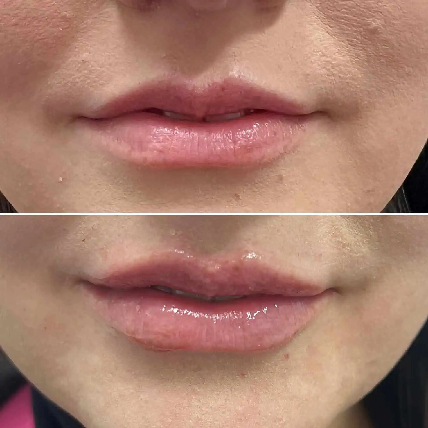 Lips-before-and-after