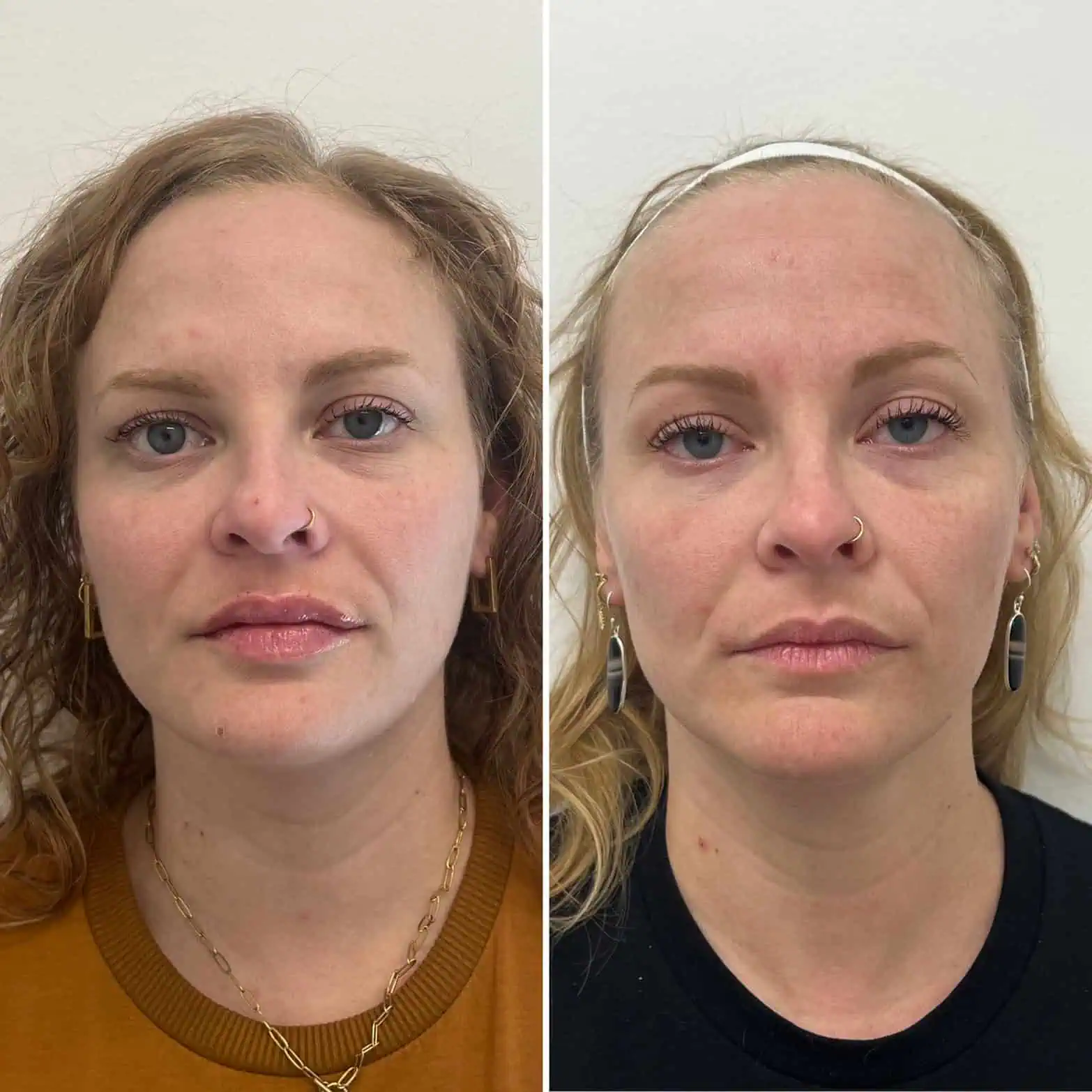 Facial-balancing-before-after